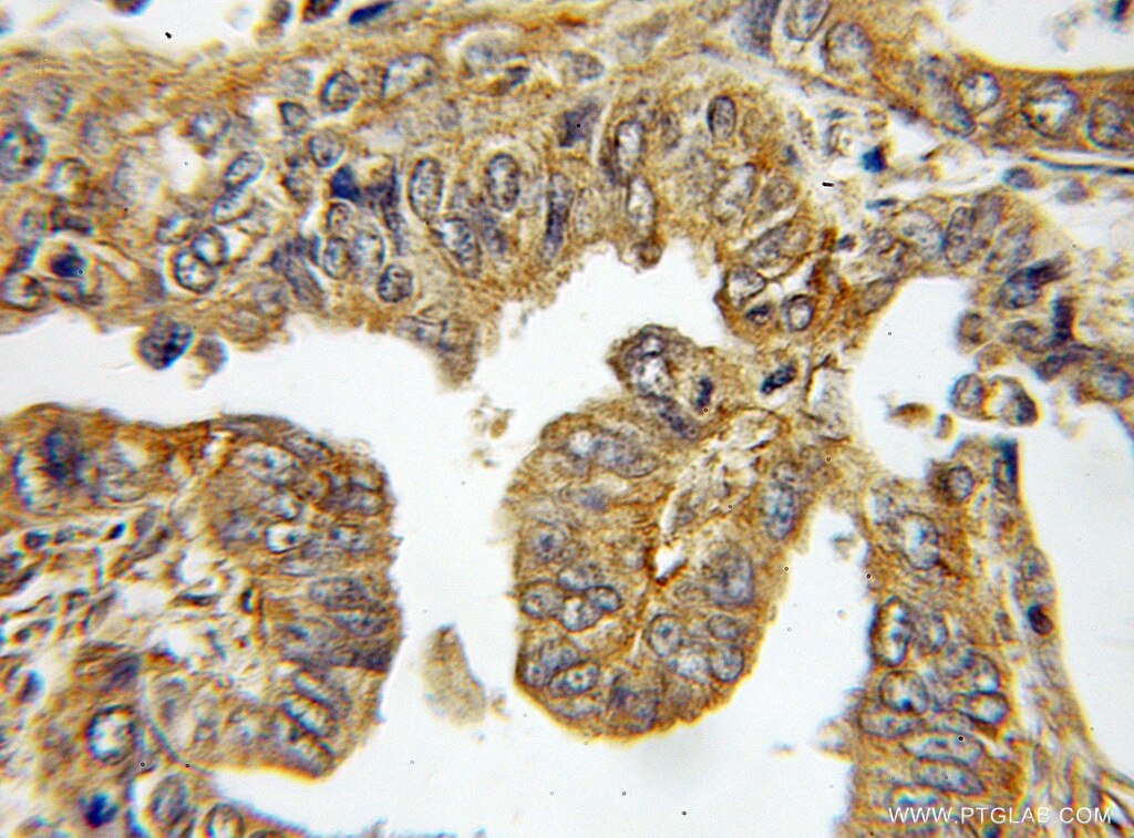 Immunohistochemistry (IHC) staining of human ovary tumor tissue using NRG4 Polyclonal antibody (11206-1-AP)
