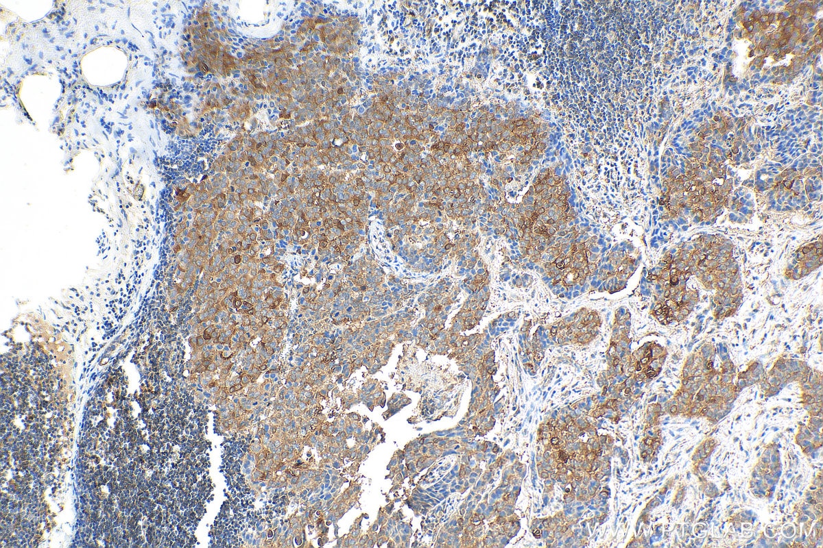 Immunohistochemistry (IHC) staining of human breast cancer tissue using NRG4 Polyclonal antibody (27292-1-AP)