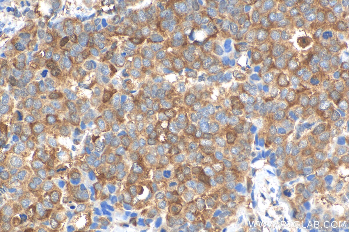 Immunohistochemistry (IHC) staining of human breast cancer tissue using NRG4 Polyclonal antibody (27292-1-AP)