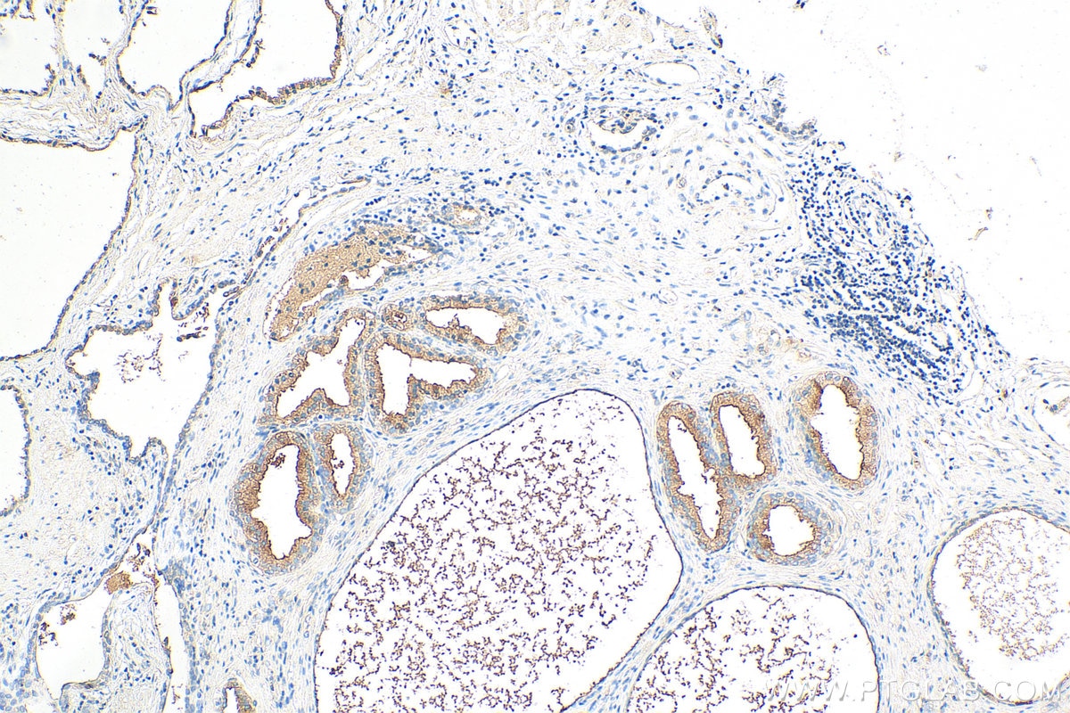 IHC staining of human prostate cancer using 27292-1-AP