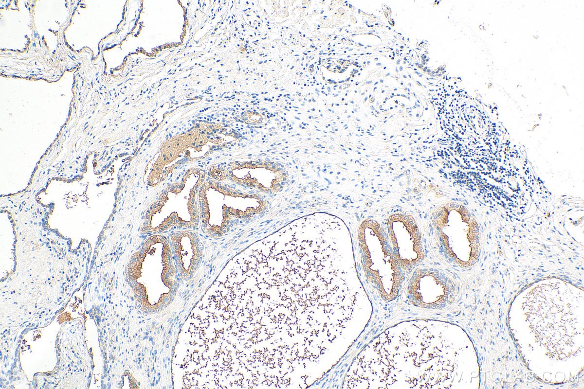 Immunohistochemistry (IHC) staining of human prostate cancer tissue using NRG4 Polyclonal antibody (27292-1-AP)