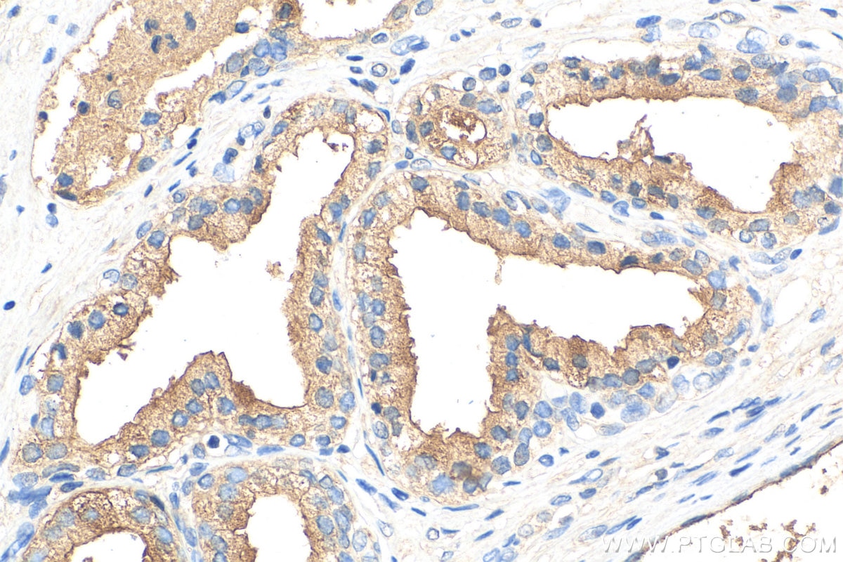 Immunohistochemistry (IHC) staining of human prostate cancer tissue using NRG4 Polyclonal antibody (27292-1-AP)