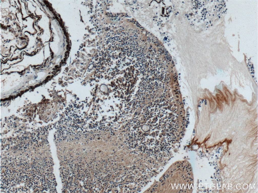 Immunohistochemistry (IHC) staining of human retinoblastoma tissue using NRL Polyclonal antibody (17388-1-AP)