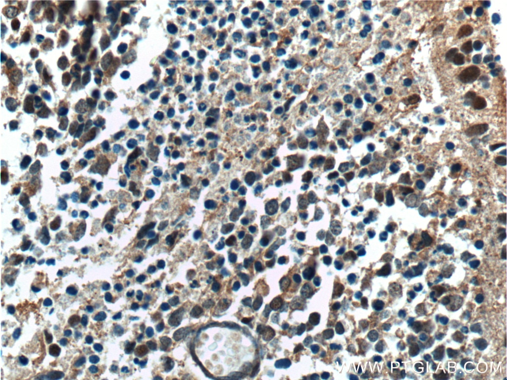 Immunohistochemistry (IHC) staining of human retinoblastoma tissue using NRL Polyclonal antibody (17388-1-AP)