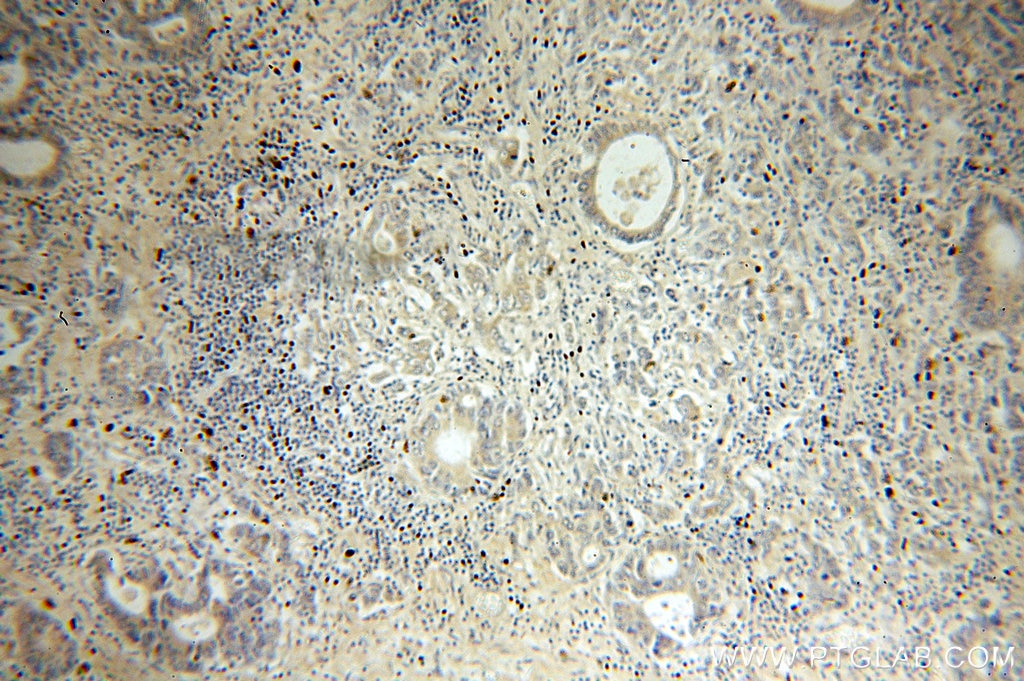 Immunohistochemistry (IHC) staining of human stomach cancer tissue using NSDHL Polyclonal antibody (15111-1-AP)