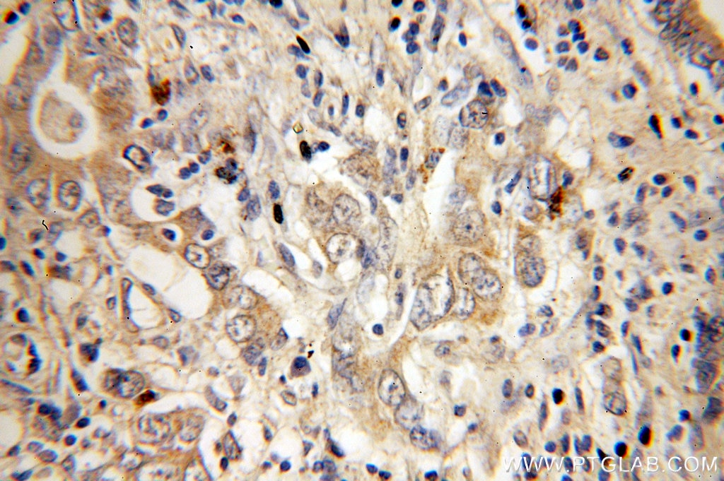 Immunohistochemistry (IHC) staining of human stomach cancer tissue using NSDHL Polyclonal antibody (15111-1-AP)