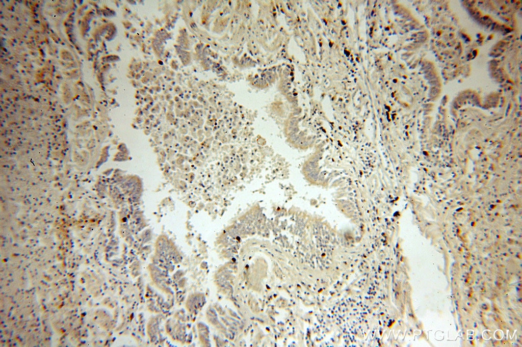 IHC staining of human lung cancer using 15111-1-AP