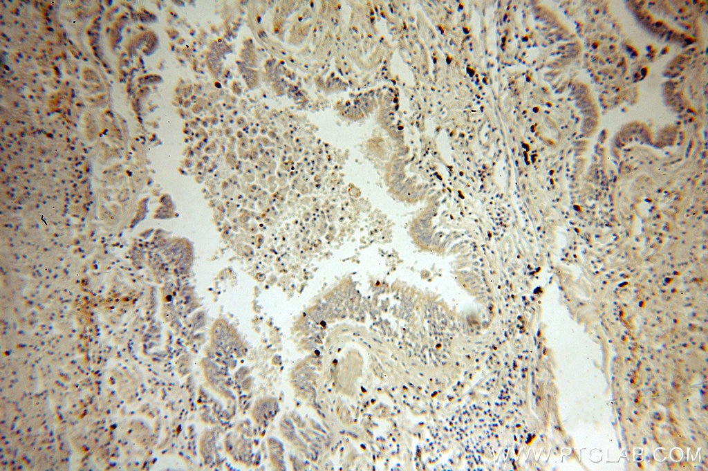 Immunohistochemistry (IHC) staining of human lung cancer tissue using NSDHL Polyclonal antibody (15111-1-AP)