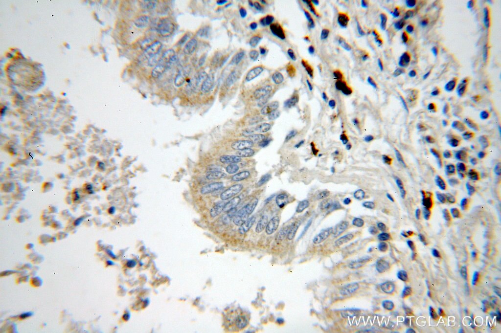 Immunohistochemistry (IHC) staining of human lung cancer tissue using NSDHL Polyclonal antibody (15111-1-AP)
