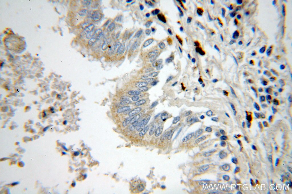 IHC staining of human lung cancer using 15111-1-AP