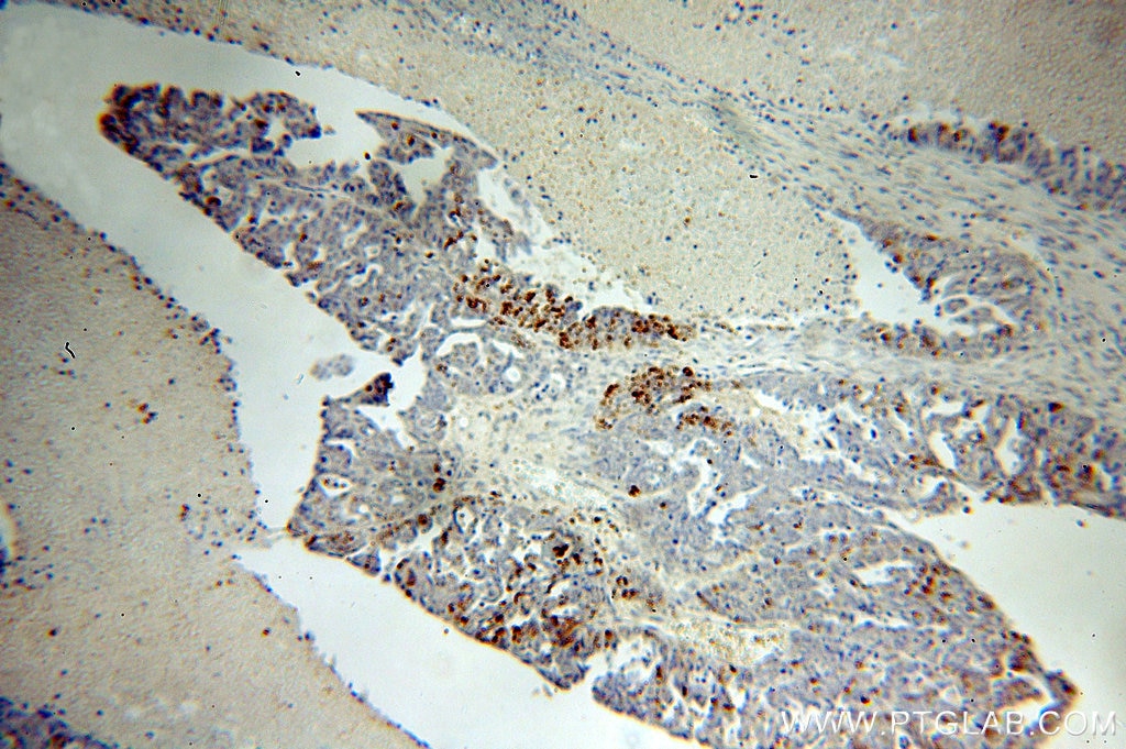 IHC staining of human ovary tumor using 15111-1-AP