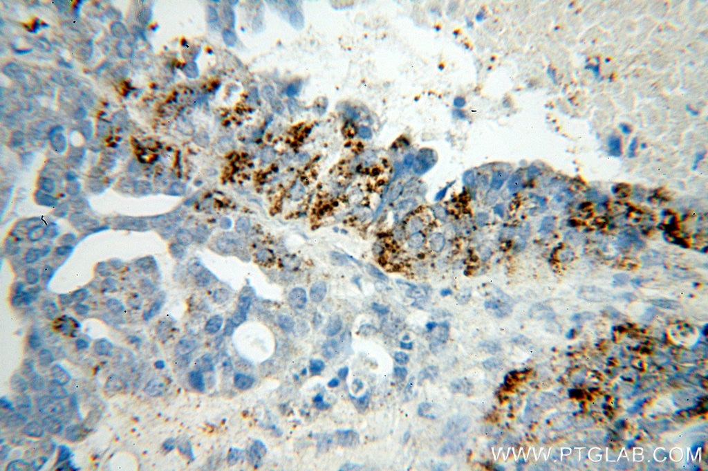 Immunohistochemistry (IHC) staining of human ovary tumor tissue using NSDHL Polyclonal antibody (15111-1-AP)