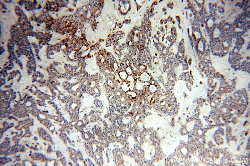 Immunohistochemistry (IHC) staining of human cervical cancer tissue using NSDHL Polyclonal antibody (15111-1-AP)
