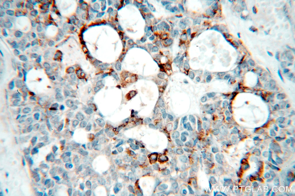 Immunohistochemistry (IHC) staining of human cervical cancer tissue using NSDHL Polyclonal antibody (15111-1-AP)