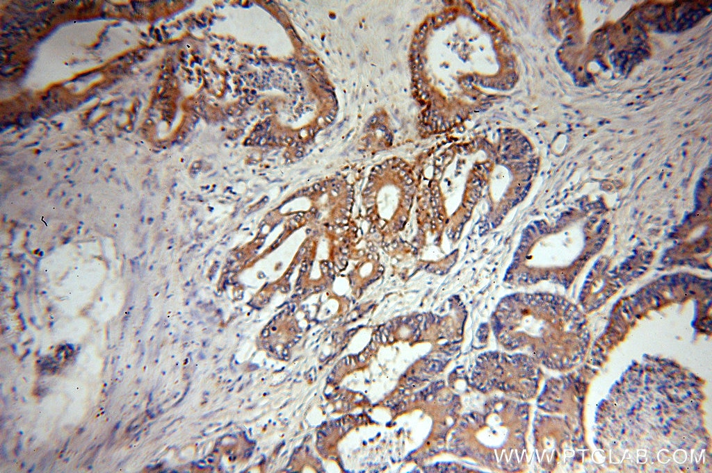 IHC staining of human colon cancer using 15111-1-AP