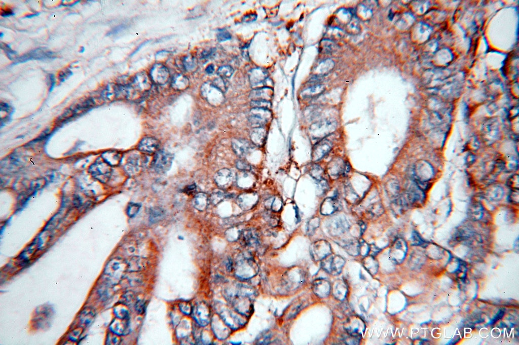 Immunohistochemistry (IHC) staining of human colon cancer tissue using NSDHL Polyclonal antibody (15111-1-AP)