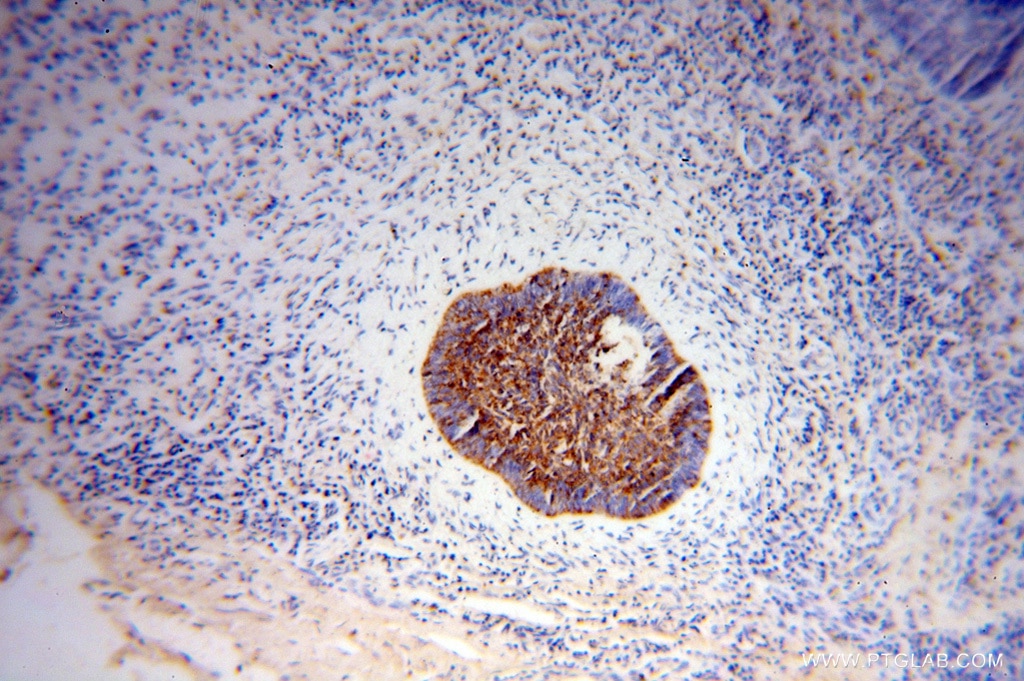 Immunohistochemistry (IHC) staining of human skin cancer tissue using NSDHL Polyclonal antibody (15111-1-AP)