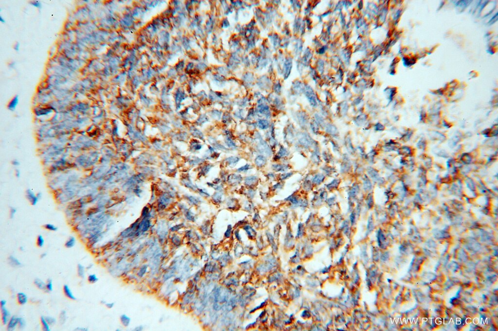 Immunohistochemistry (IHC) staining of human skin cancer tissue using NSDHL Polyclonal antibody (15111-1-AP)