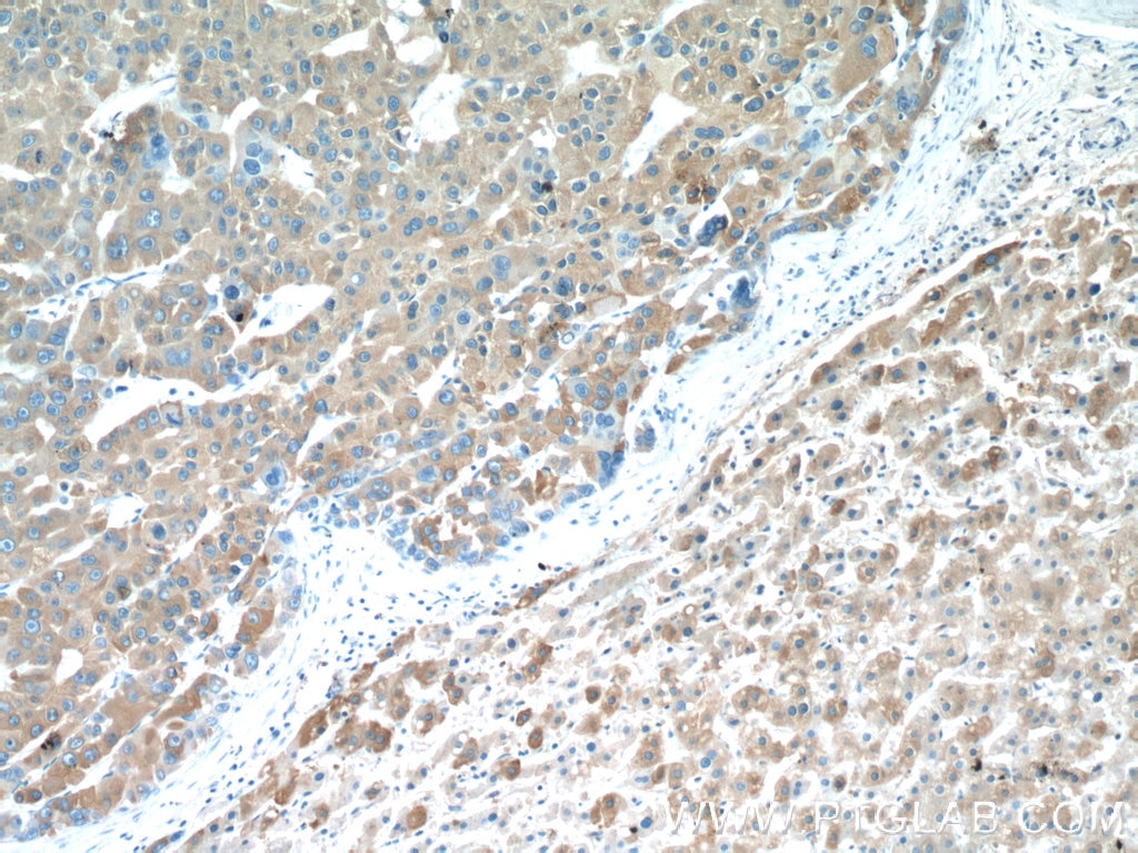 Immunohistochemistry (IHC) staining of human liver cancer tissue using NSFL1C Polyclonal antibody (15620-1-AP)