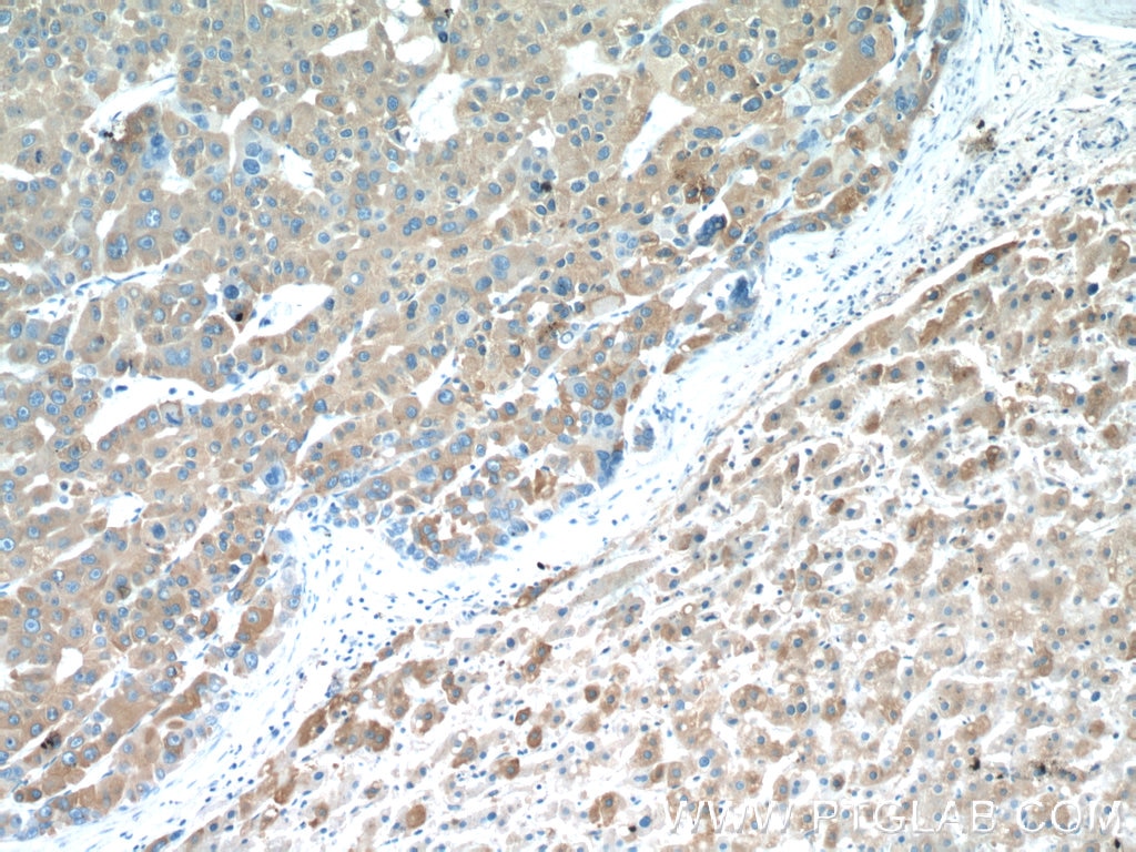 IHC staining of human liver cancer using 15620-1-AP