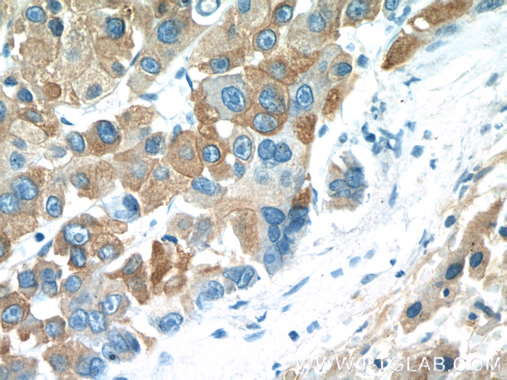 Immunohistochemistry (IHC) staining of human liver cancer tissue using NSFL1C Polyclonal antibody (15620-1-AP)