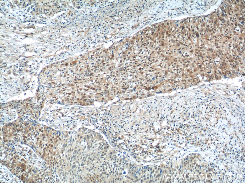 Immunohistochemistry (IHC) staining of human lung cancer tissue using NSFL1C Polyclonal antibody (15620-1-AP)