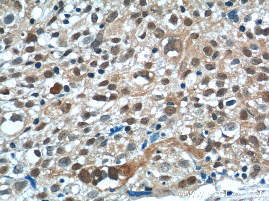 Immunohistochemistry (IHC) staining of human lung cancer tissue using NSFL1C Polyclonal antibody (15620-1-AP)