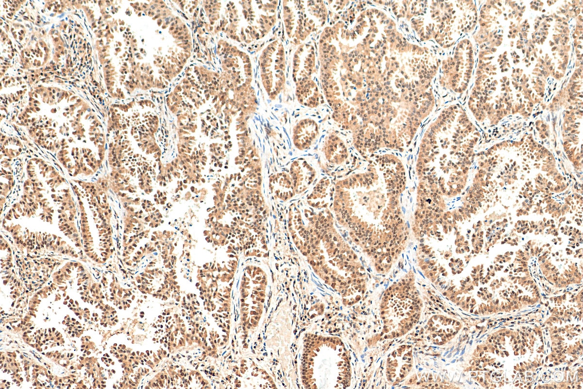 Immunohistochemistry (IHC) staining of human lung cancer tissue using NSFL1C Monoclonal antibody (68182-1-Ig)