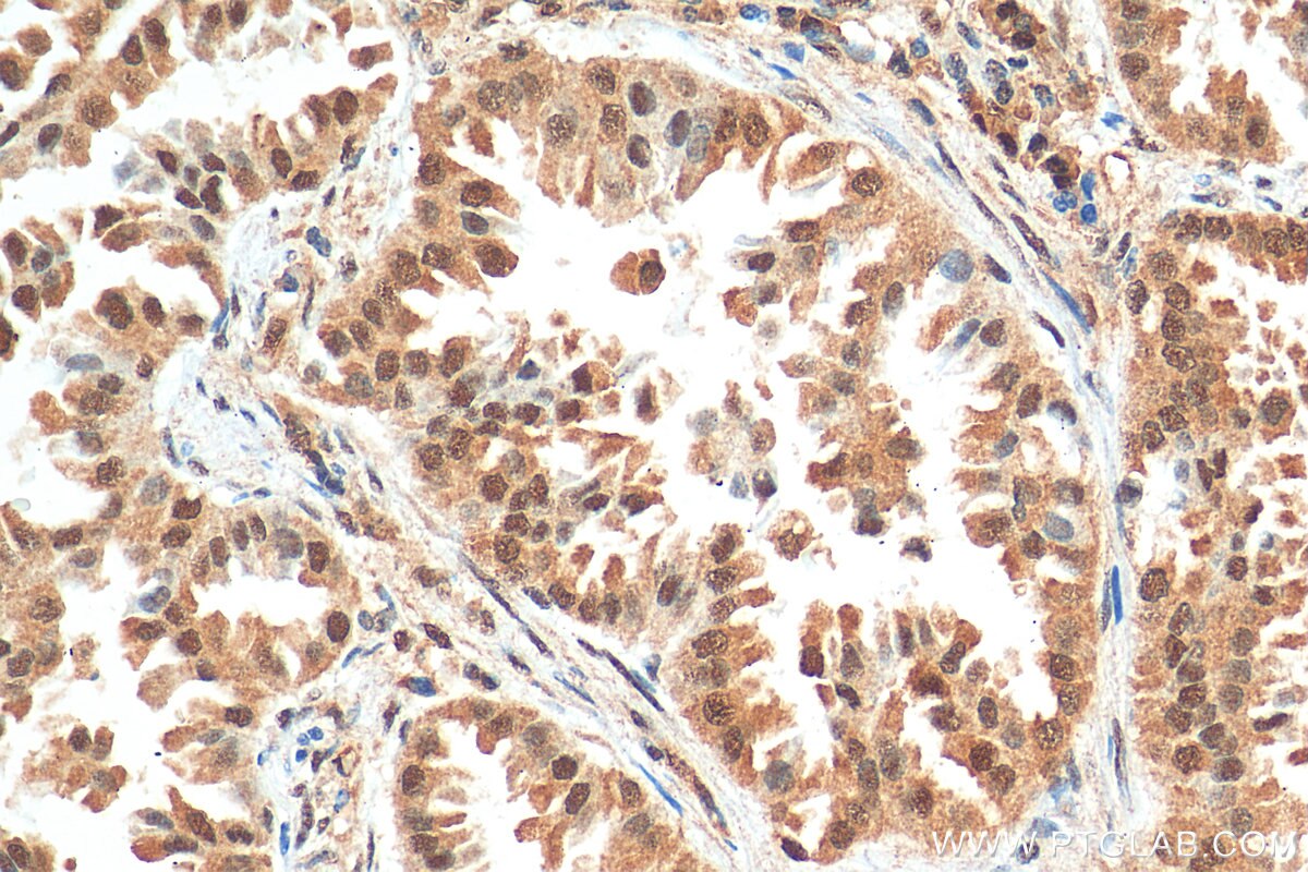 Immunohistochemistry (IHC) staining of human lung cancer tissue using NSFL1C Monoclonal antibody (68182-1-Ig)