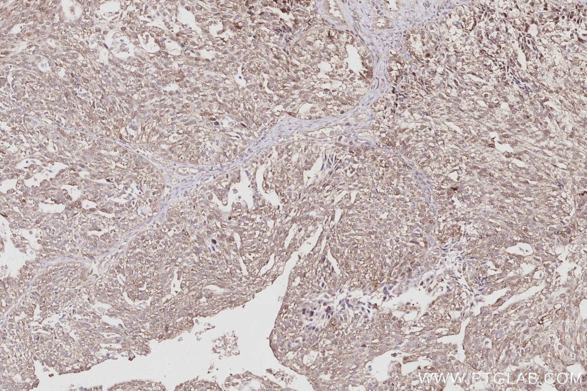 IHC staining of human ovary cancer using 68182-1-Ig Immunohistochemistry (IHC) staining of human ovary cancer tissue using NSFL1C Monoclonal antibody (68182-1-Ig)