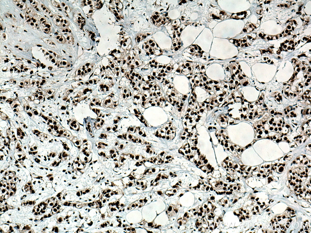 Immunohistochemistry (IHC) staining of human breast cancer tissue using NSUN2 Polyclonal antibody (20854-1-AP)