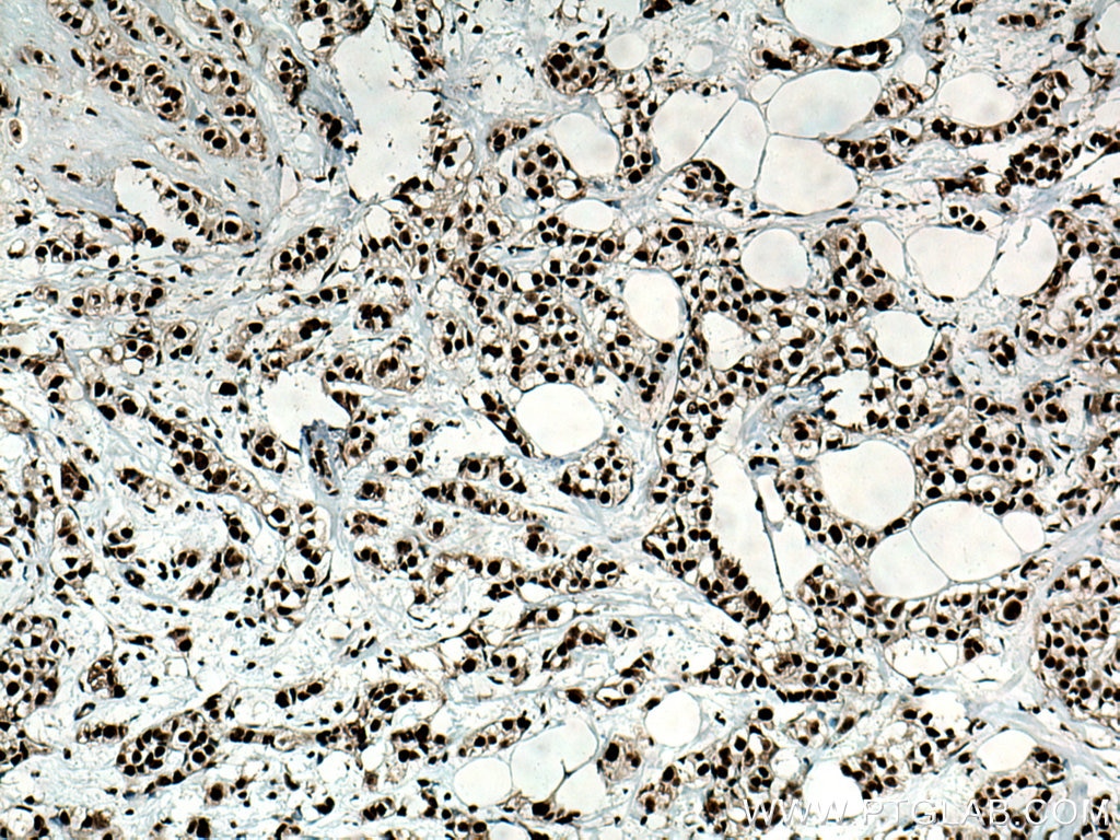 IHC staining of human breast cancer using 20854-1-AP