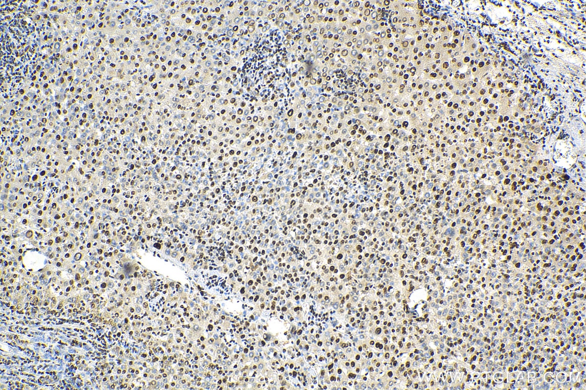 Immunohistochemistry (IHC) staining of human liver cancer tissue using NSUN2 Polyclonal antibody (20854-1-AP)