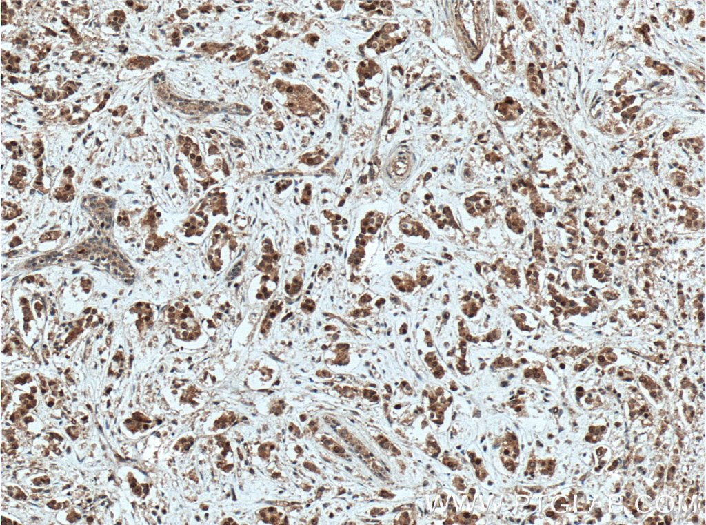 Immunohistochemistry (IHC) staining of human breast cancer tissue using NSUN2 Monoclonal antibody (66580-1-Ig)