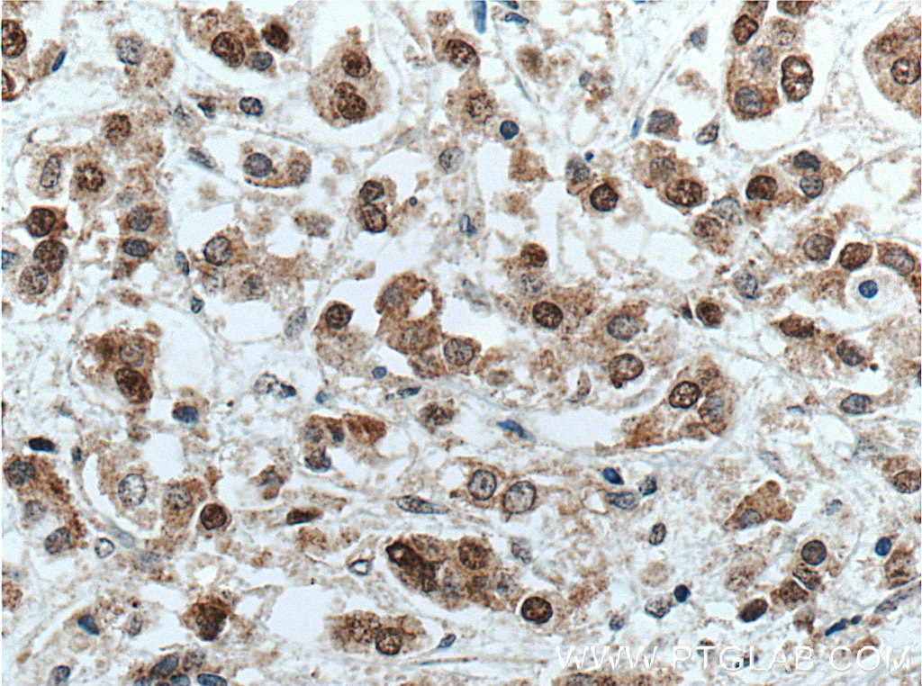 Immunohistochemistry (IHC) staining of human breast cancer tissue using NSUN2 Monoclonal antibody (66580-1-Ig)