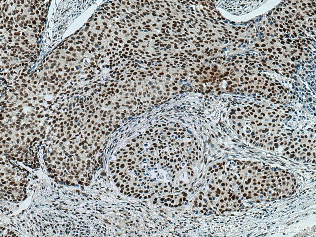 Immunohistochemistry (IHC) staining of human oesophagus cancer tissue using NSUN2 Monoclonal antibody (66580-1-Ig)