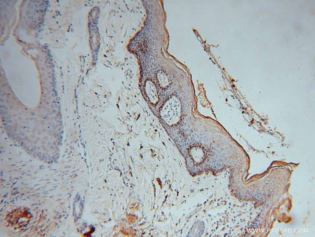 Immunohistochemistry (IHC) staining of human skin cancer tissue using NSUN5 Polyclonal antibody (15449-1-AP)