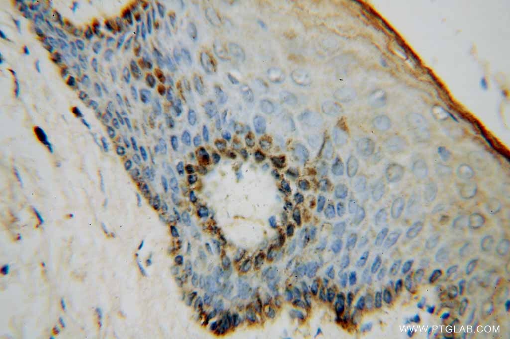 Immunohistochemistry (IHC) staining of human skin cancer tissue using NSUN5 Polyclonal antibody (15449-1-AP)