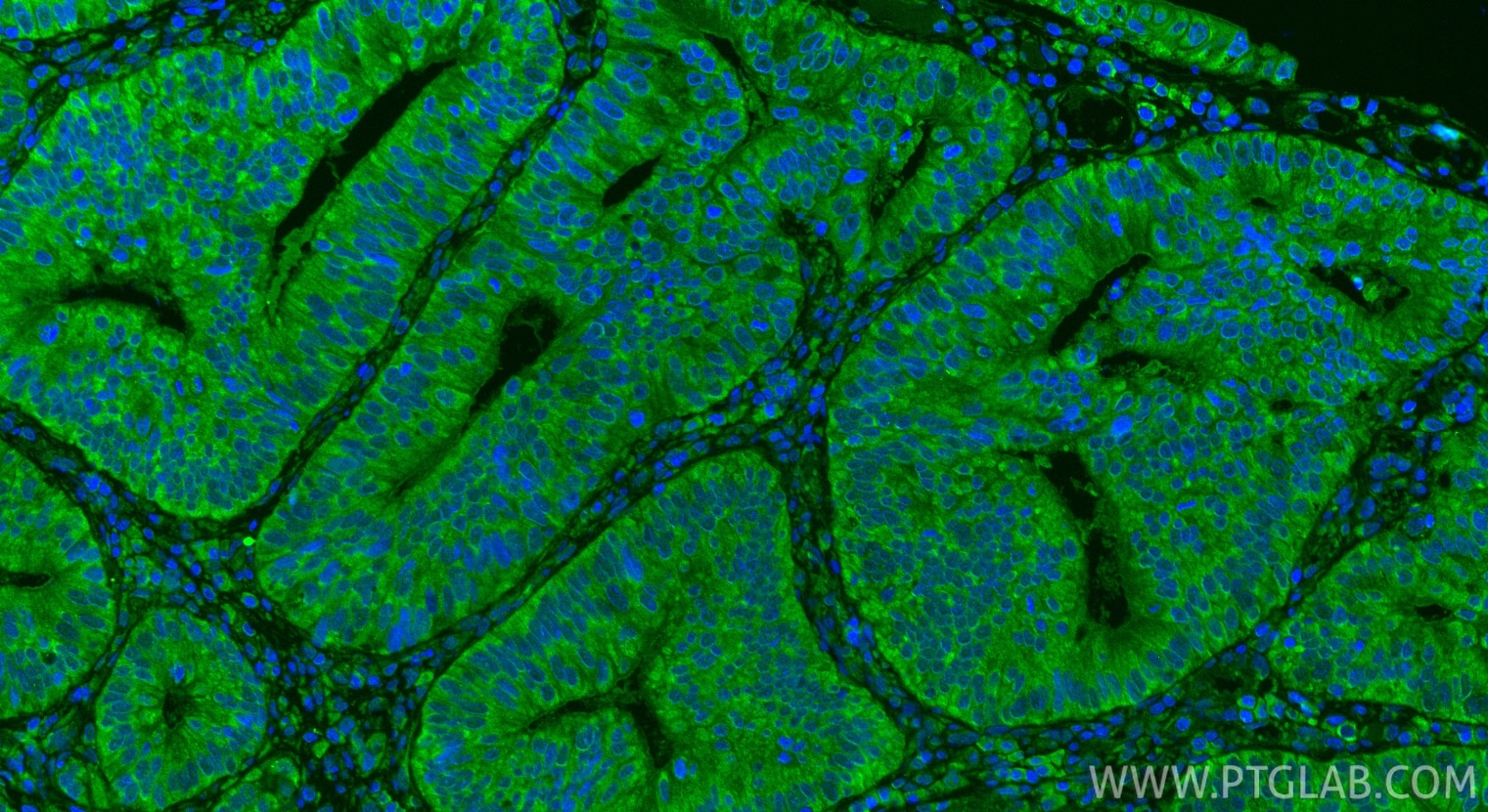 Immunofluorescence (IF) / fluorescent staining of human colon cancer tissue using NSUN6 Polyclonal antibody (17240-1-AP)