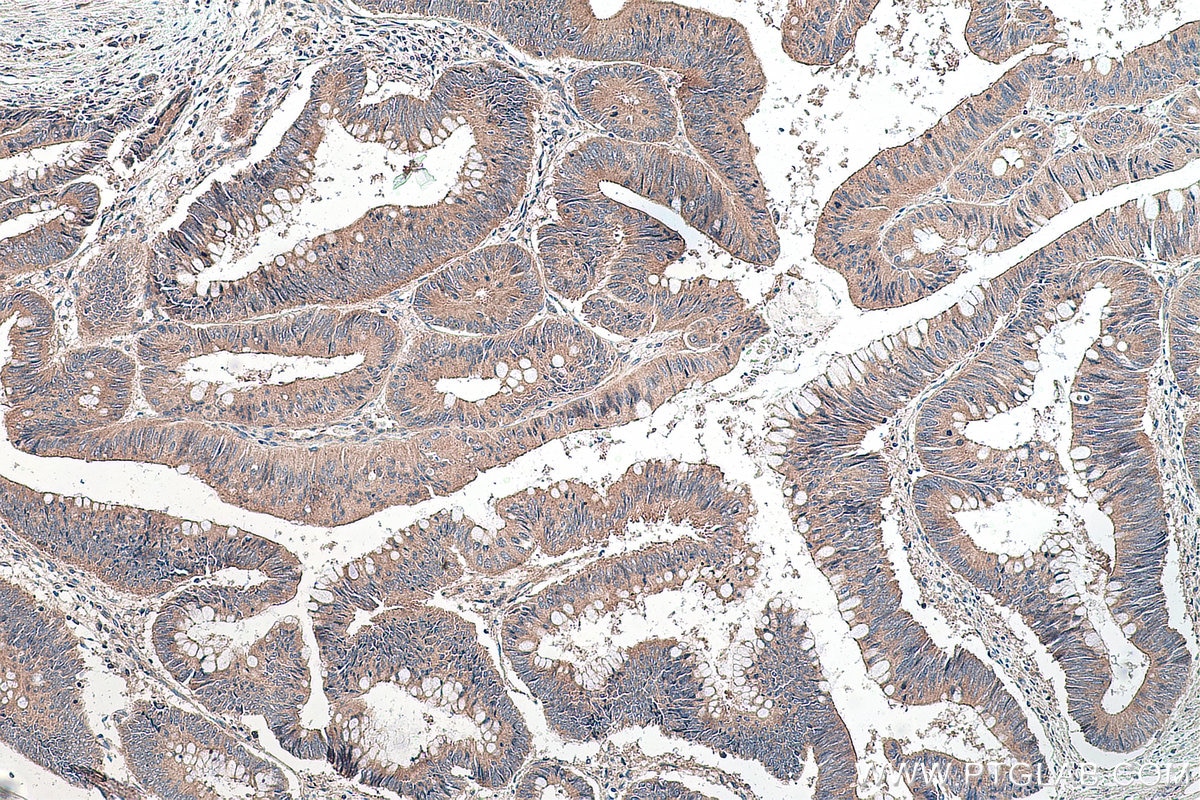 Immunohistochemistry (IHC) staining of human colon cancer tissue using NSUN6 Polyclonal antibody (17240-1-AP)