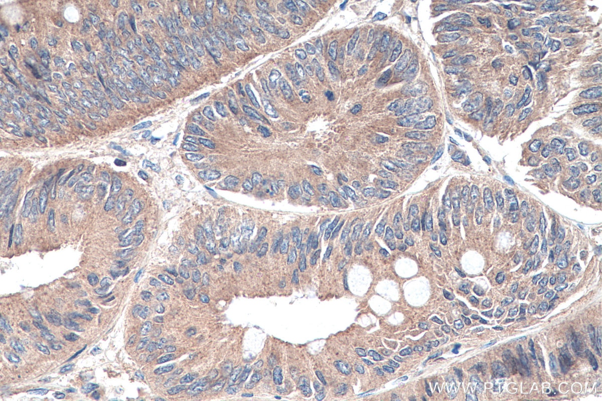 Immunohistochemistry (IHC) staining of human colon cancer tissue using NSUN6 Polyclonal antibody (17240-1-AP)