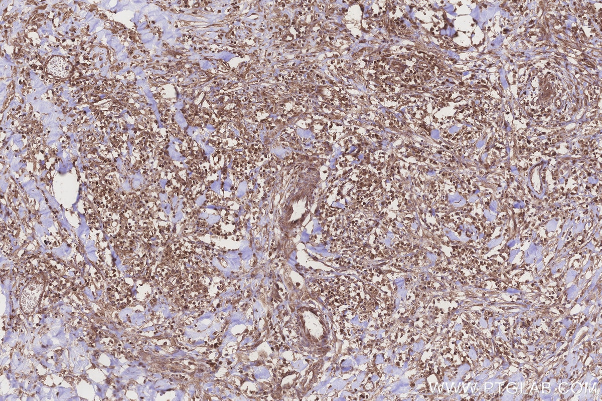 Immunohistochemistry (IHC) staining of human colon cancer tissue using NT5C2 Polyclonal antibody (15223-1-AP)