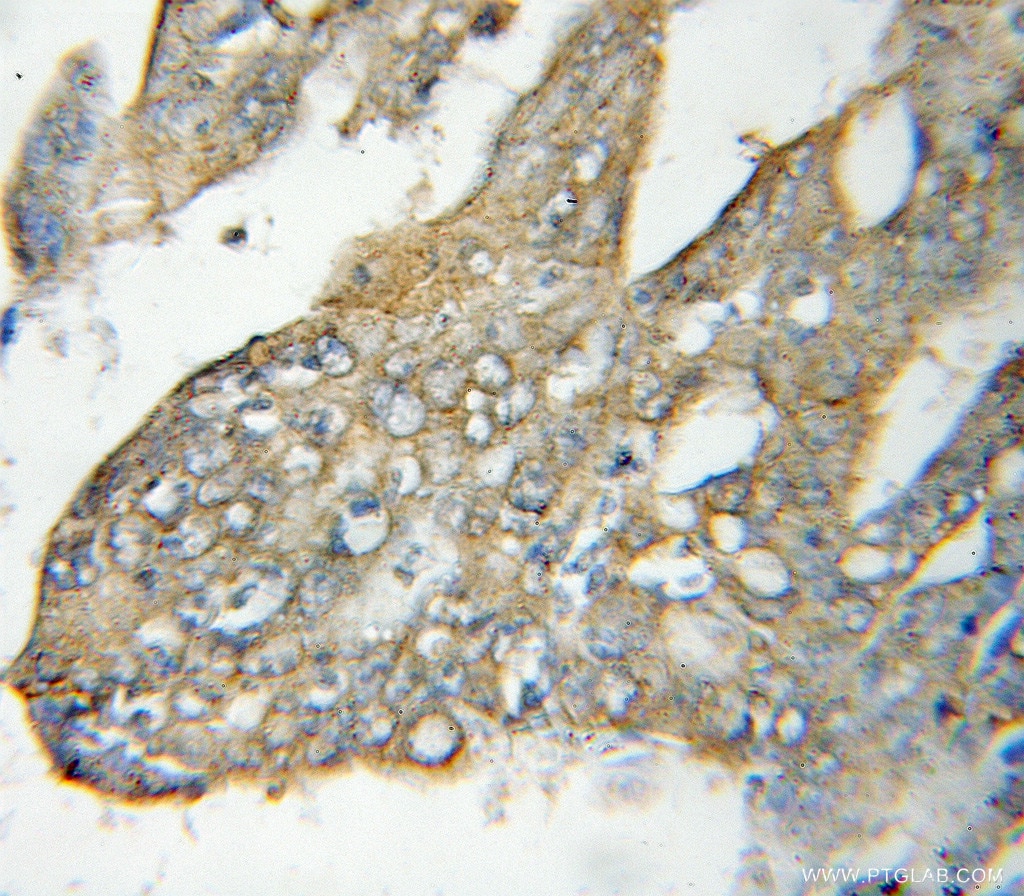 Immunohistochemistry (IHC) staining of human colon cancer tissue using NT5C3 Polyclonal antibody (11393-1-AP)