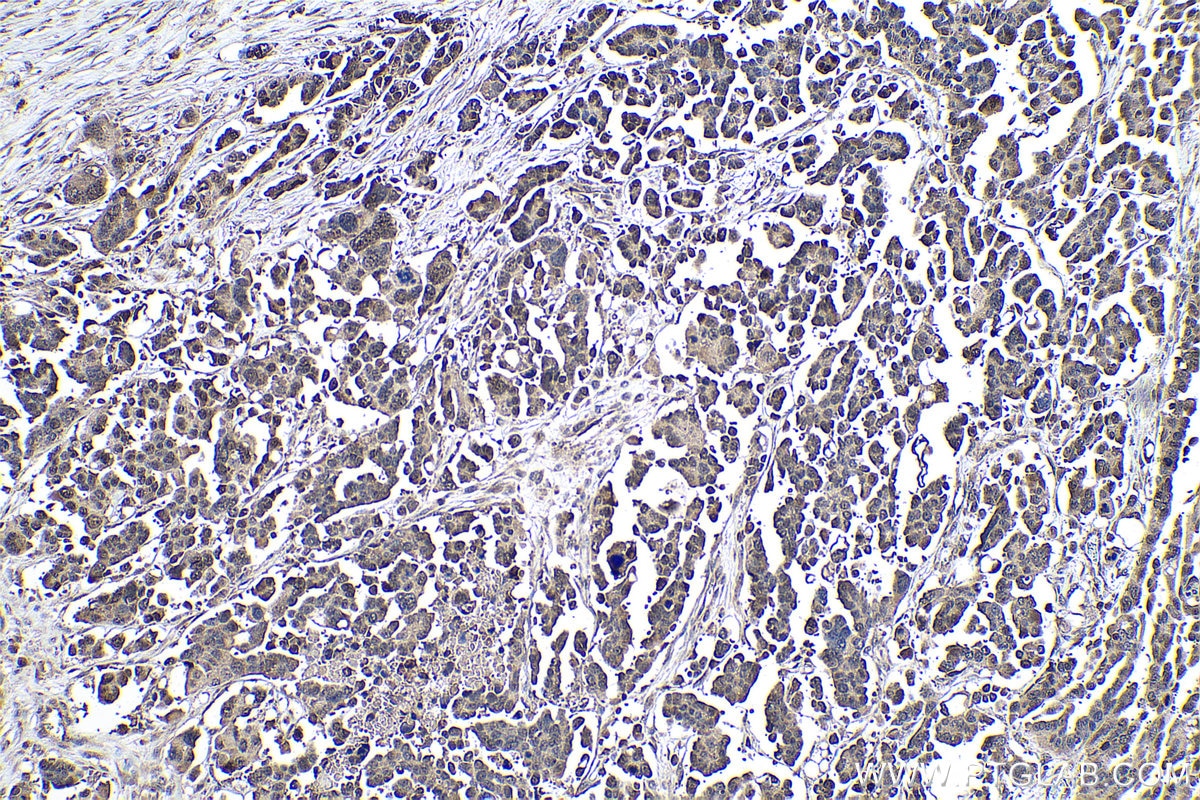 Immunohistochemistry (IHC) staining of human colon cancer tissue using NT5DC1 Polyclonal antibody (24102-1-AP)