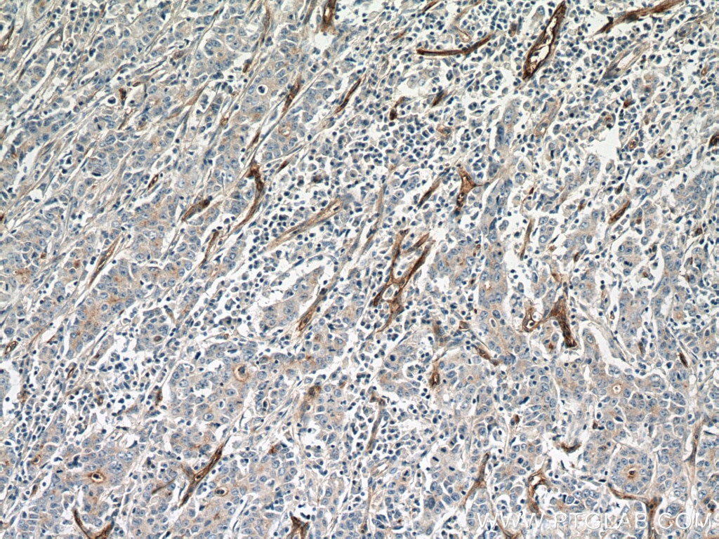 Immunohistochemistry (IHC) staining of human stomach cancer tissue using NT5E/CD73 Polyclonal antibody (12231-1-AP)
