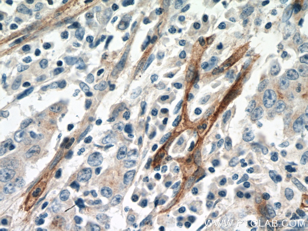 Immunohistochemistry (IHC) staining of human stomach cancer tissue using NT5E/CD73 Polyclonal antibody (12231-1-AP)