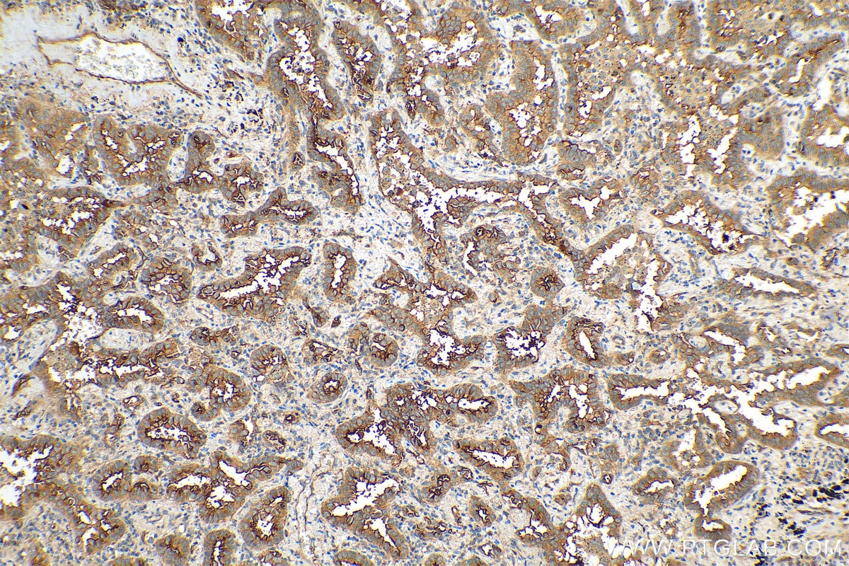 IHC staining of human lung cancer using 12231-1-AP