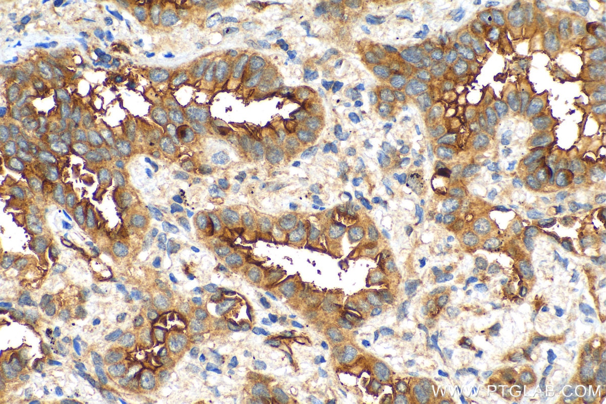 Immunohistochemistry (IHC) staining of human lung cancer tissue using NT5E/CD73 Polyclonal antibody (12231-1-AP)