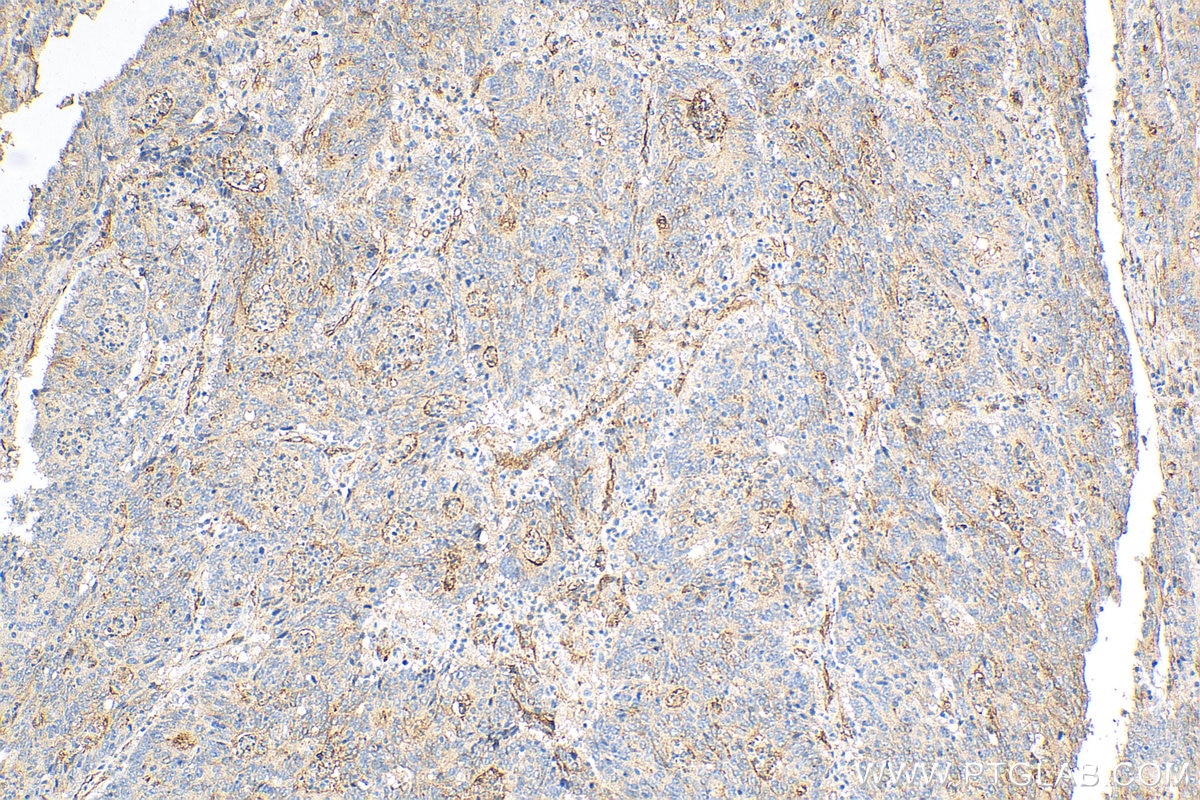 Immunohistochemistry (IHC) staining of human colon cancer tissue using NT5E/CD73 Polyclonal antibody (12231-1-AP)