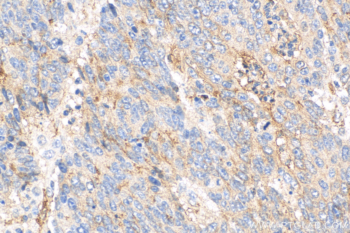 Immunohistochemistry (IHC) staining of human colon cancer tissue using NT5E/CD73 Polyclonal antibody (12231-1-AP)